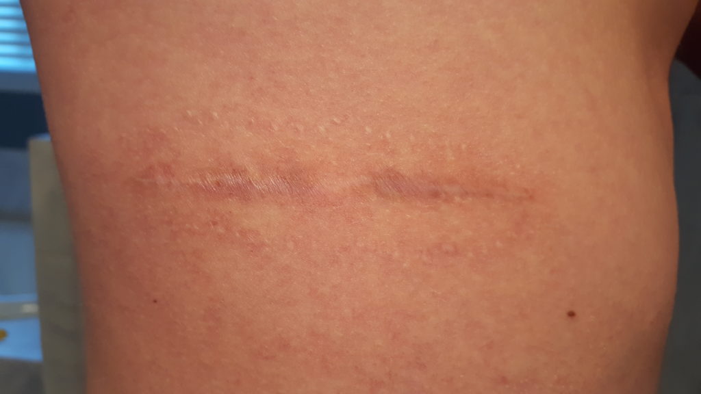My scar